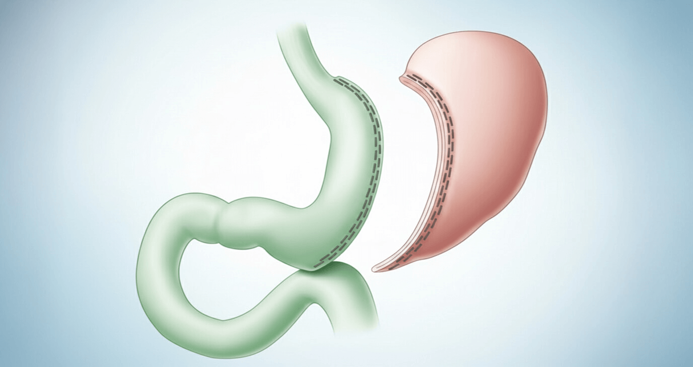 Бариатрическая операция | Geropharm-trends.ru